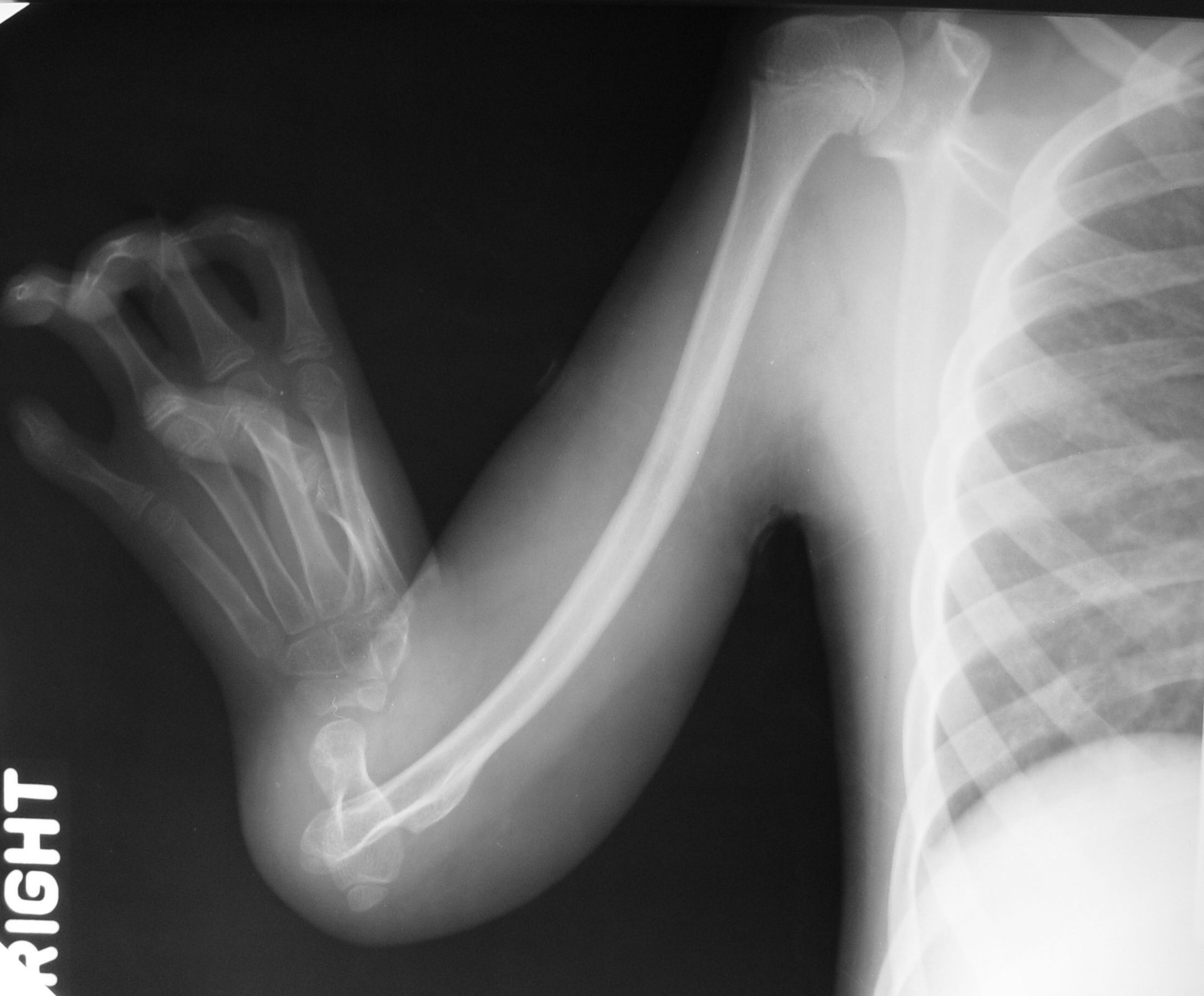 icd 10 code for thrombocytopenia with absent radius